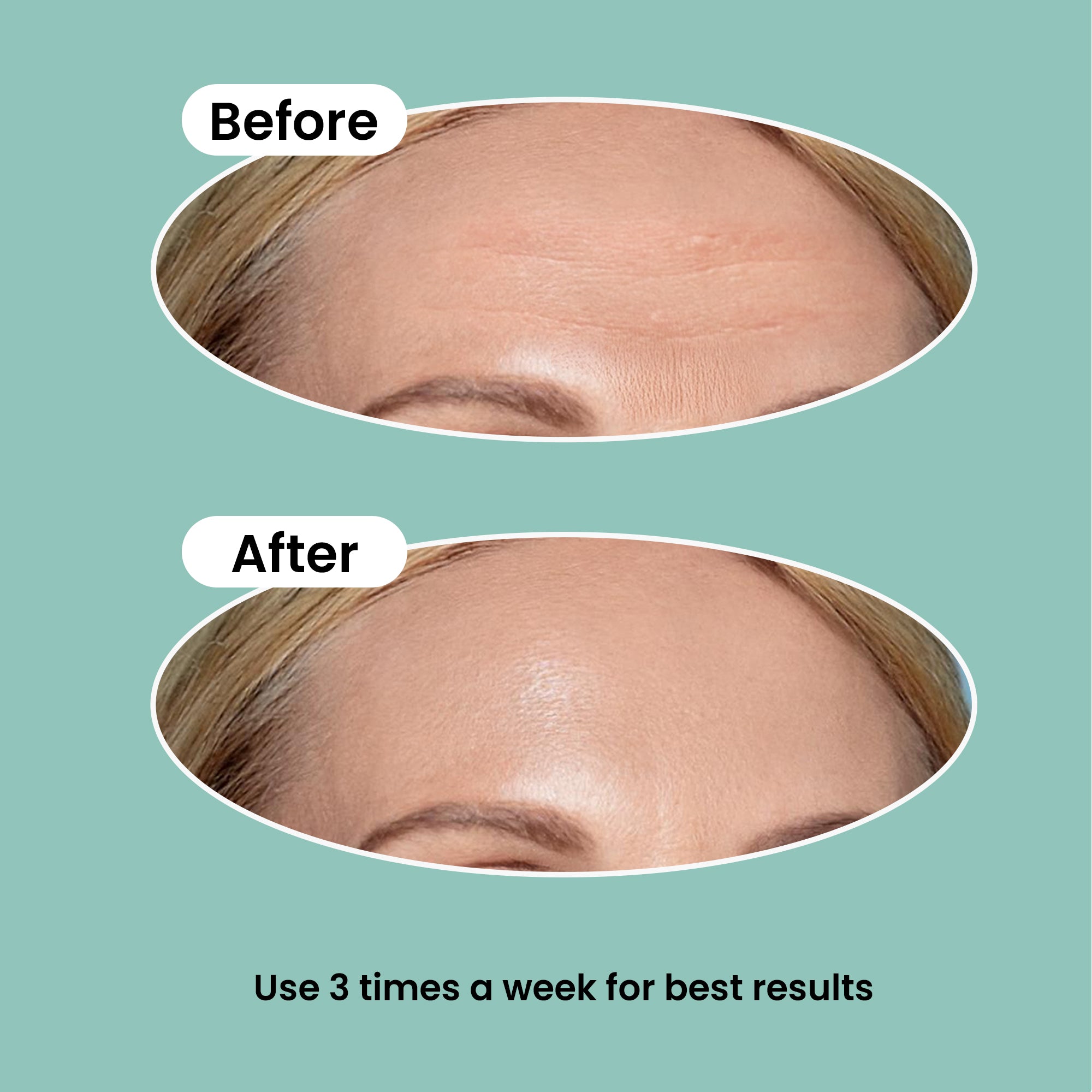 Forehead Wrinkle Patches with Retinol 20ct | Patches for Forehead Wrinkles