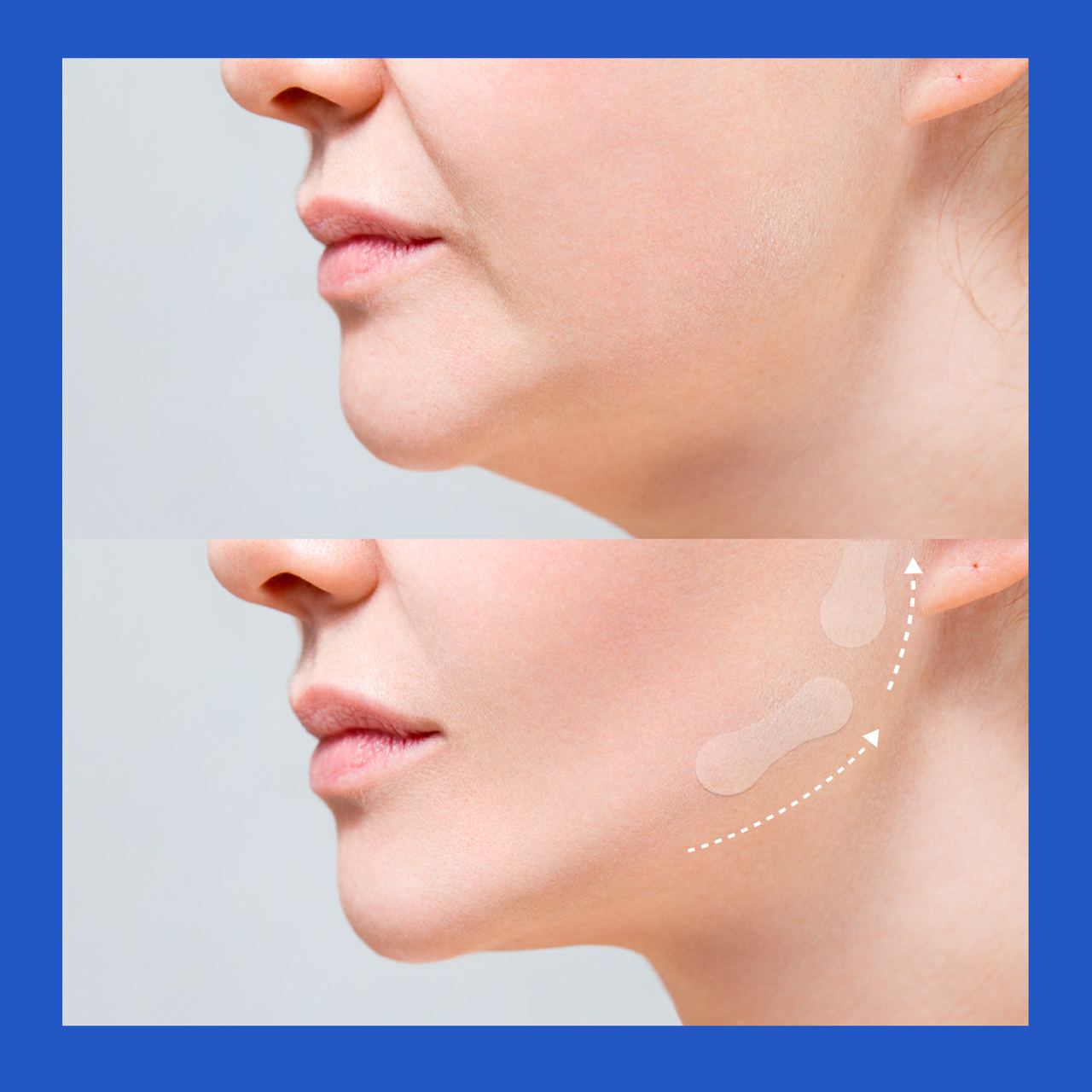 Invisible Face Lifting Tape